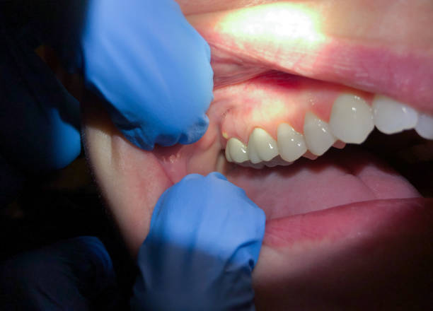 Best Emergency Tooth Extraction in Spiro, OK